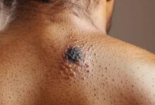 İzmir Cilt Kanseri Tedavisi