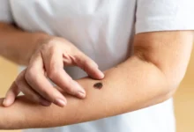 Türkiye Cilt Kanser Tedavisi