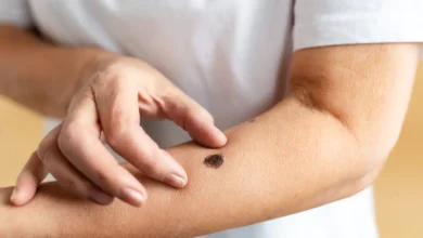 Türkiye Cilt Kanser Tedavisi